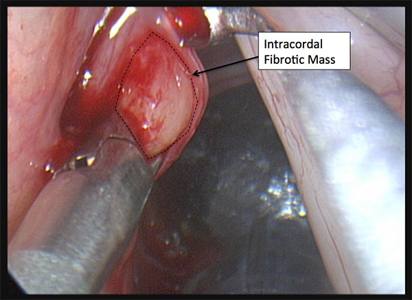 Figure 2: Dissection was performed around the mass until it was freed from the normal tissue.