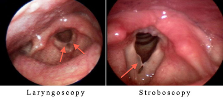 Figure 1: Two images taken from the same patient’s vocal folds using fiberoptic laryngoscopy (left) and rigid stroboscopy (right). Note that the polyp seen in the stroboscopy image looks like vocal nodules in the low-resolution fiberoptic laryngoscopy image.