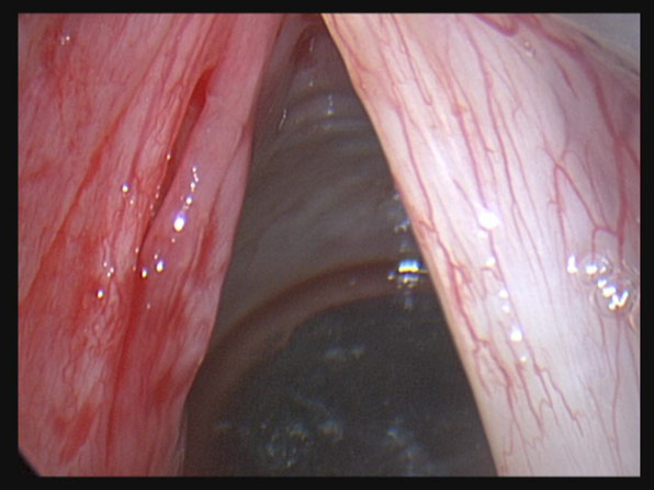 Figure 3: After removal, the contour of the vocal fold margin was now straight. The vocal fold erythema (redness) was expected due to the prolonged period of time with blood in the fold.