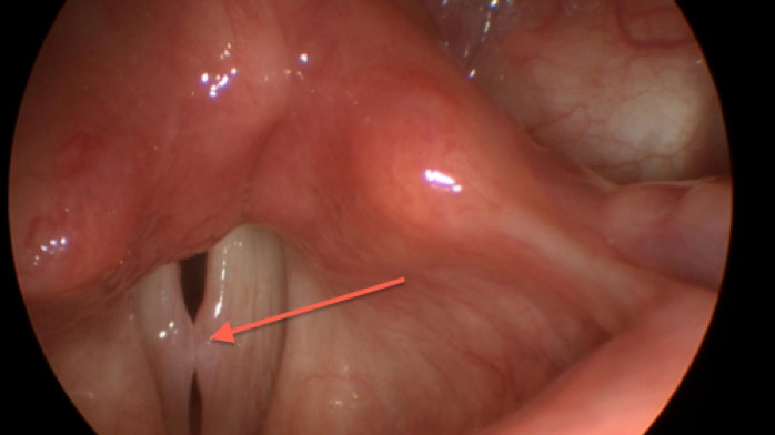 Figure 1: Stroboscopy image of the vocal folds demonstrating bilateral vocal nodules (arrow)