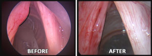 Read more about the article Voice Case of the Week: Hoarseness after Voice Use