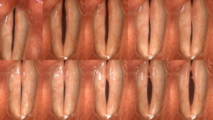 Read more about the article Voice Case of the Week: Scarring From Surgery