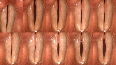 Figure 1: One vibratory cycle, demonstrating good posterior closure but with mid-vocal fold insufficiency secondary to depression of the edge. This is due to vocal scarring from a loss of superficial lamina propria.