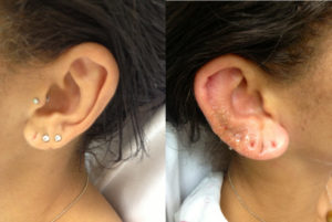 Read more about the article Complications of Ear Piercing: Perichondritis and Ear Disfigurement