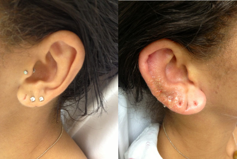 Figure 1: Perichondritis of the right ear that has progressed to chondritis (right). Note the discoloration, inflammation, and grainy appearance of the skin compared to the normal left ear (left).