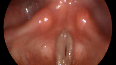 Figure: Stroboscopy imaging of the larynx demonstrating laryngitis.