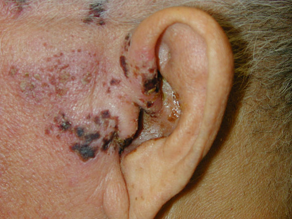 Figure 1: Herpes zoster oticus typically results in an itchy rash that is characterized by fluid filled bumps (vesicles)1.
