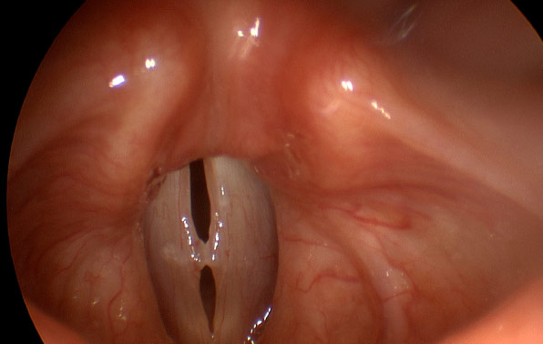 Figure 1: On videostroboscopy, frame-by-frame analysis allows for determination of complex pathologies. In this case, mucous obscures the picture but polyps are clearly visible in 3-4 frames per cycle. Traditional laryngoscopy could have easily misinterpreted these polyps as mucus.