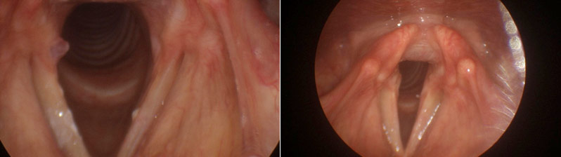 Figure 3: Stroboscopy demonstrating near total resolution of the vocal process granuloma. 