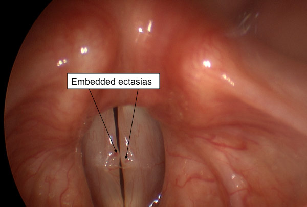 Figure 2: Frame by frame analysis also allows for viewing of the polyps on lateral excursion, when they compress into the vocal fold superficial lamina propria. This permits the view of large ectasias (vascular lakes) embedded within the vocal folds. 