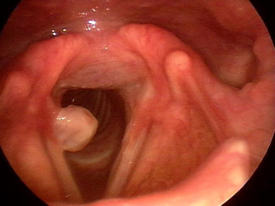 Figure 1: Stroboscopy image of the larynx demonstrating a right vocal process granuloma.