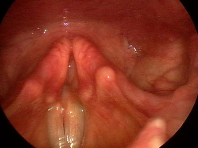 Figure 2: Note that the right vocal process granuloma has prolapsed below the vocal folds during phonation.