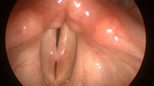 Read more about the article Voice Case of the Week: Do Nodules Need Surgery?