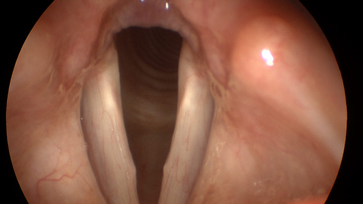 Figure 3: Stroboscopy imaging of the larynx demonstrating vocal cords with significant improvement in nodular thickening and resolution of redness.