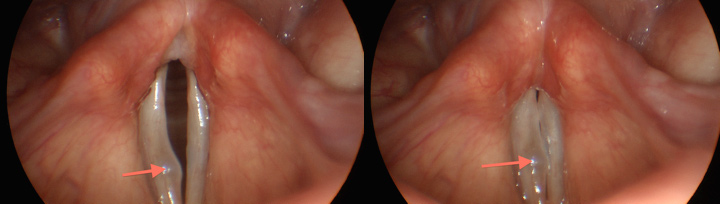 Figure: Stroboscopy image of the vocal cords demonstrating polypoid corditis (arrow).