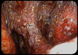 Figure 3: Nasolaryngoscopy image of HHT patient demonstrating scaling and dried blood.
