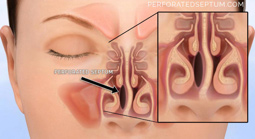 Figure 2: Schematic demonstrating a common location for septal defects.