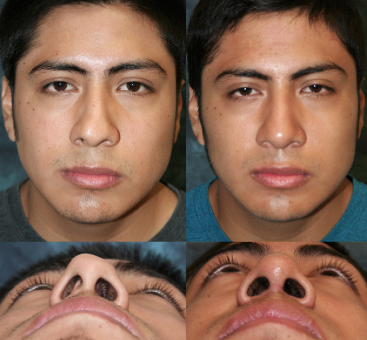 Figure 2: Before (Left) and after (Right) surgical correction of an old nasal fracture. 