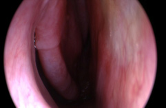Figure 4: Nasal endoscopy demonstrates above patient after correction of deviated septum and septal perforation.