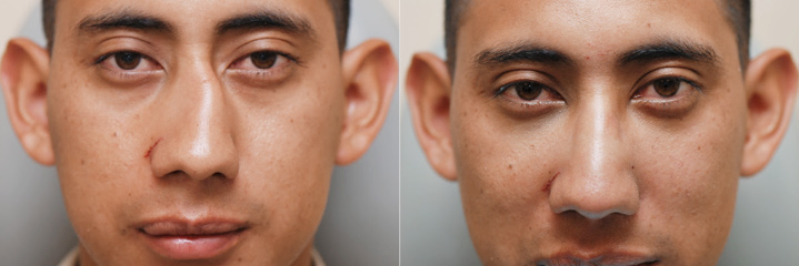 Figure 1: Before (Left) and after (Right) photo of patient who underwent a closed nasal reduction within one week of nasal fracture.