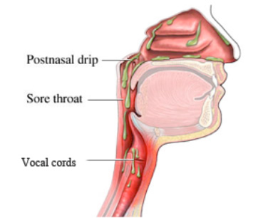 Figure 1: Diagram of the head and neck depicting the course of postnasal drip.