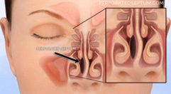 Figure 2: Schematic demonstrating a deviated septum and septal perforation location for septal defects.
