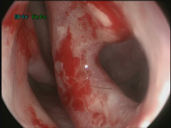 Figure 3: Nasal endoscopy demonstrates patient right sided deviated nasal septum with anterior septum perforation.