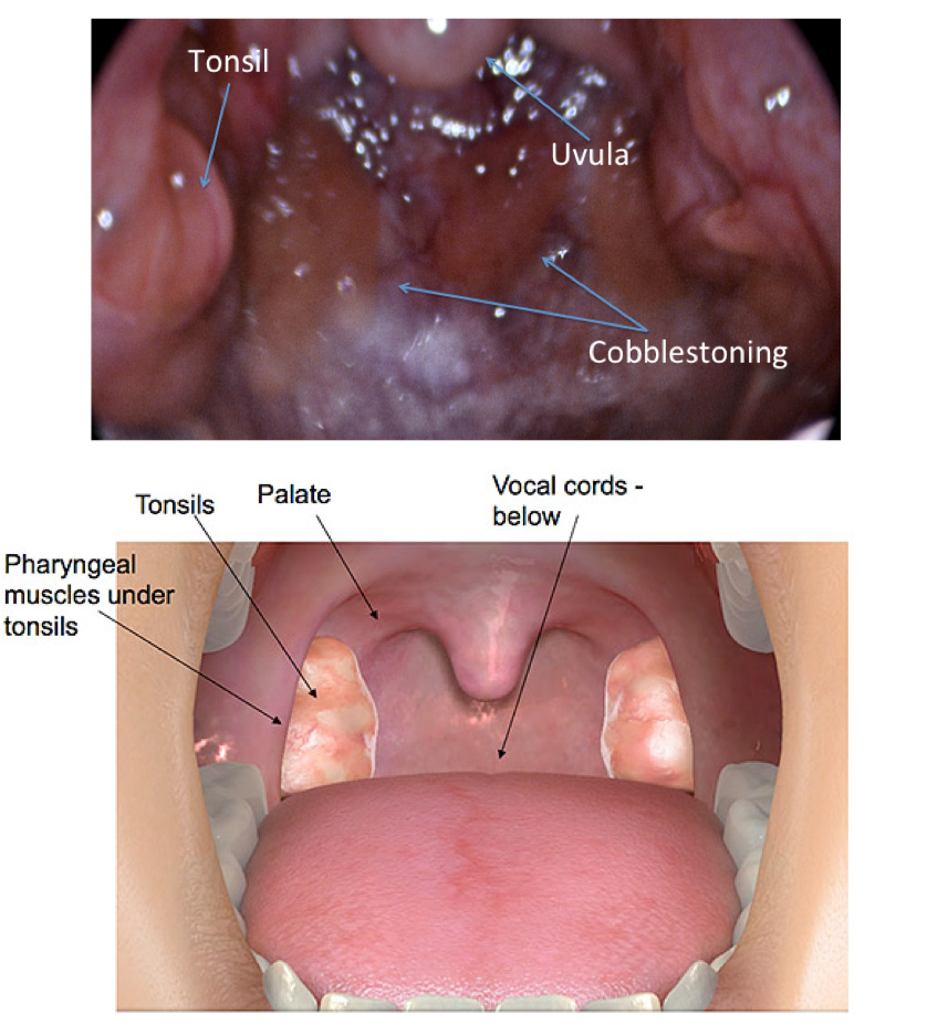 Figure 2: Photographic(top) and artistic rendition(bottom) of the tonsil and throat (oropharynx) demonstrating cobblestoning, one of the visible changes of postnasal drip. 