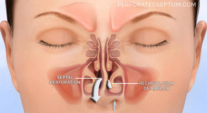 Figure 2. Perforated septum is a hole in the nasal septum that cause excessive drying of the nasal passages leading to nosebleeds, infections, foul smelling odors, and nasal collapse.