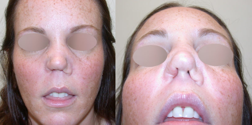 Figure 1. Long-term cocaine effects on the nose. Pictures show septal perforation and massive nasal collapse from super infection of the nasal skeleton after cocaine use.