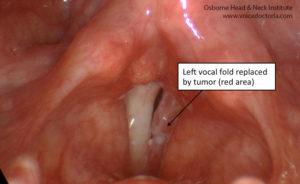 Read more about the article Voice Case of the Week: Timeline of Consultation for Hoarseness