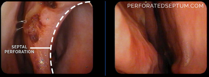 Figure 4a, 4b. Septal perforation (left) showing crusting, dry blood and a large opening through the nasal septum. Perforated septum repair (right) showing complete closure of the perforated septal defect with no evidence of disease.