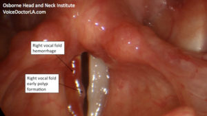 Read more about the article Voice Case of the Week: Prolonged Vocal Hemorrhage from Herbal Supplements