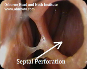 Read more about the article Septal Perforation: Long-Term Outcomes