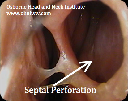 Figure 1: Nasopharyngoscopy demonstrating nasal septal perforation.