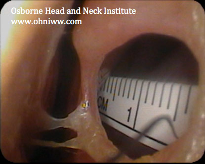 Figure 2: Nasal septum perforation. A ruler has been inserted into the opposite nostril to demonstrate scale.