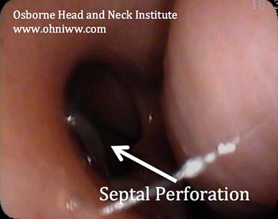 Figure 3: Nasopharyngoscopy demonstrating a nasal septum perforation in a pediatric patient.