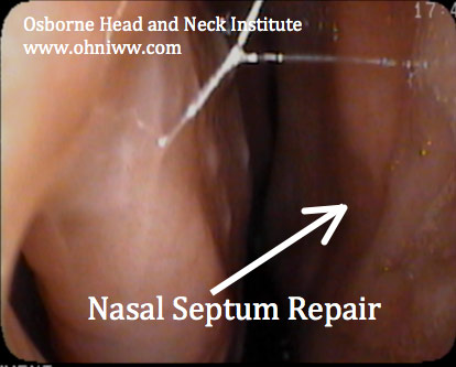 Figure 3: Nasopharyngoscopy demonstrating septal perforation repair.