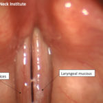 Voice Case of the Week: Larynx Injury from Inhalation