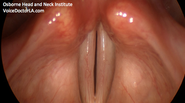 larynx-treatment