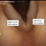 Voice Case of the Week: When Nodules Need Surgery