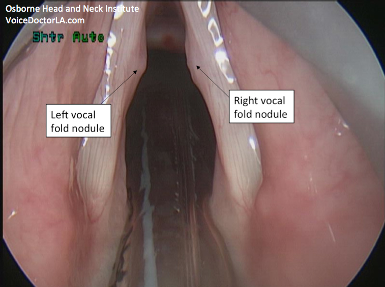 vocal-nodules-treatment