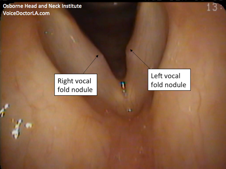 A trial of voice therapy was suggested and the patient was compliant. However, she did not note any improvement. A decision was therefore made to perform conservative surgery. Intraoperatively, this is the image of her vocal folds. Note that operative views are rotated 180 degrees, so that right is right and left is left (unlike office laryngoscopy which is like a mirror – left is right and right is left).