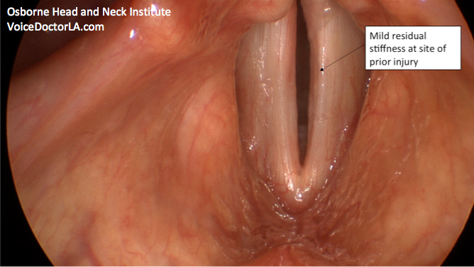 vocal-polyp-treatment