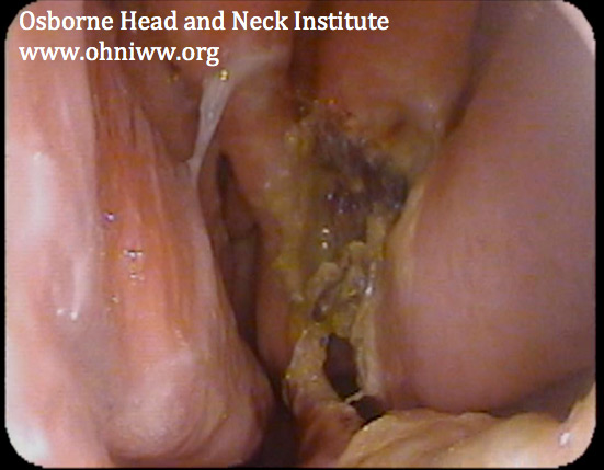 Figure 1: Nasopharyngoscopy demonstrating a mega-perforation of the nasal septum.
