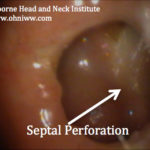 Septoplasty Complication and Septal Perforation
