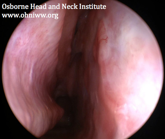 Figure 3: Nasopharyngoscopy demonstrating nasal septal perforation repair.