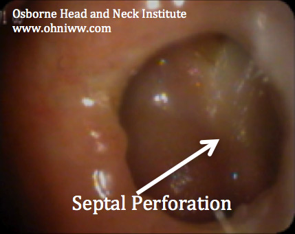 Figure 1: Nasopharyngoscopy demonstrating nasal septal perforation.