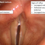 Voice Case of the Week: Sometimes it is Reflux