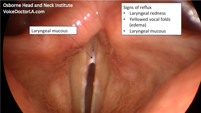 reflux-treatment